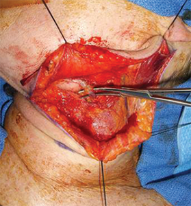 Division of the facial vein followed by superior retraction of the submandibular gland protects the marginal mandibular nerve without the need to identify it, while affording wide exposure to access level II of the neck.