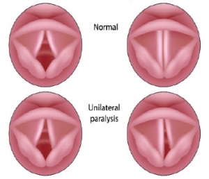 Treatment Options for Vocal Fold Paralysis - ENTtoday