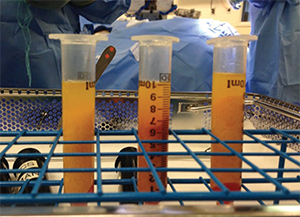 Autologous fat, shown as centrifuged fat.