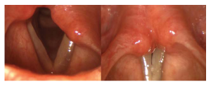 The vocal folds in abduction and during phonatory adduction on rigid strobolaryngoscopic examination. Most examiners found a left-sided (97%) paresis involving the recurrent laryngeal nerve (74%). Examiners indicated decreased VF abduction, slow/sluggish VF movement, and decreased VF adduction as the most compelling clinical findings in diagnosis. Credit: © The American Laryngological, Rhinological and Otological Society, Inc.