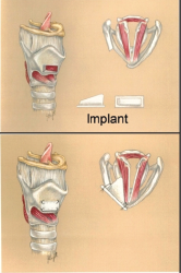 Medialization laryngoplasty procedure.q