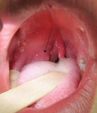 Right-sided peritonsilar abscess.