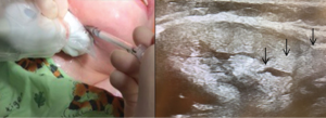 Botulinum toxin A injection into the right submandibular gland under ultrasound guidance. Positioning of the ultrasound probe in the submandibular region (left) and ultrasound image of the Botox injection with the black arrows highlighting the tract of the needle as it enters the submandibular gland (right).