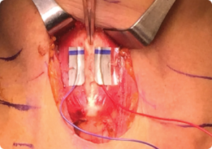 Anterior laryngeal electrode positioning on the laminae of the thyroid cartilage. Forceps indicate the midline thyroid cartilage notch. © 2018 The American Laryngological, Rhinological and Otological Society, Inc.