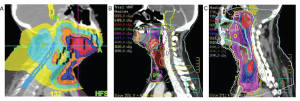 Images from treatment plans illustrating differences in radiation treatment for a patient with (A) an identified HPV-positive base-of-tongue primary tumor, (B) an HPV-positive metastasis without identified primary, and (C) an HPV-negative metastasis without identified primary. © 2019 The American Laryngological, Rhinological and Otological Society, Inc.