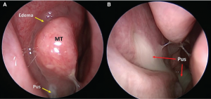 Representative nasal endoscopy findings of the middle meatus. (A) Edema and mucopurulence in the right middle meatus. (B) Purulence draining from an accessory maxillary sinus ostium through the right middle meatus and into the nasopharynx. © 2019 The American Laryngological, Rhinological and Otological Society, Inc.