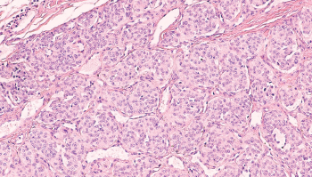 Photomicrograph of a paraganglioma.