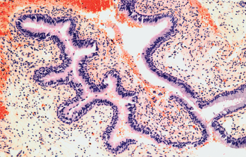 Light micrograph of a section through a nasal polyp.