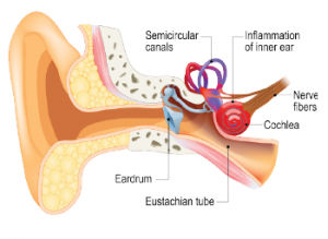 Vestibular neuritis is one of the most common causes of peripheral vestibulopathy.