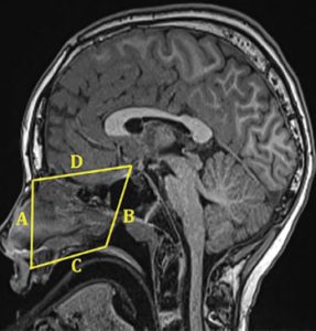 Cephalometric analysis. Measurements included (A) anterior midface height (nasion–subspinale), (B) posterior midface height (sella–posterior nasal spine), (C) palate length (subspinale–posterior nasal spine), and (D) sella–nasion distance. © 2019 The American Laryngological, Rhinological and Otological Society, Inc.