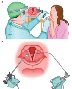 Figure 1. A) Operative setting for the procedure. The surgeon, wearing personal protective equipment, is observing the procedure on the monitor, maintaining adequate distance from the patient. The patient is seated as for routine otolaryngologic examination and is holding the tongue in a gauze. B) Schematics of the procedure. Curved microforceps for indirect laryngeal operations, held in the surgeon’s right hand, is aiming for the lesion of the right vocal fold, under the visual guidance of the rigid telelaryngoscope held in the surgeon’s left hand.