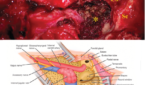 Figure 1. Schematic illustration of the infratemporal fossa type A approach (IFTA-A) with tension-free anterior rerouting of the FN. A) This intraoperative photograph shows the surgical field around jugular foramen after removing the jugular foramen paragangliomas with the modified surgical procedures. B) This illustration demonstrates anatomic structures around the jugular foramen following tension-free anterior rerouting of the facial nerve. Co = cochlea; FN = facial nerve; ICA = internal carotid artery; Sc = semicircular canal: * = jugular bulb, while the tumor was removed, and inferior petrous sinus was packed with Surgicel.