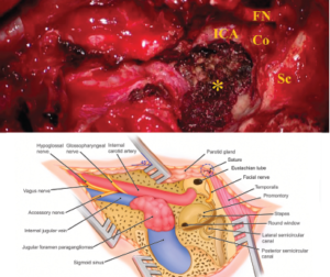 Figure 1. Schematic illustration of the infratemporal fossa type A approach (IFTA-A) with tension-free anterior rerouting of the FN. A) This intraoperative photograph shows the surgical field around jugular foramen after removing the jugular foramen paragangliomas with the modified surgical procedures. B) This illustration demonstrates anatomic structures around the jugular foramen following tension-free anterior rerouting of the facial nerve. Co = cochlea; FN = facial nerve; ICA = internal carotid artery; Sc = semicircular canal: * = jugular bulb, while the tumor was removed, and inferior petrous sinus was packed with Surgicel.