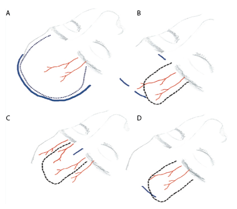 Figure 1. The pericranial flap evolution. A) Bicoronal incision. B) Zanation approach, performing two incisions in the scalp and one in the glabella. C) Single-port approach, through a unique incision in the glabella. D) Single port hidden in the scalp, avoiding any visible scar.