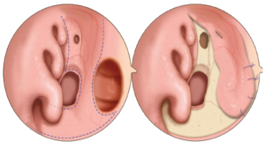 Figure 1. Schematic picture of the extended anterior ethmoidal artery (AEA) flap. (Left) Endoscopic view of the limits of the AEA flap, including the entire mucosa of the nasal floor and inferior meatus flap and the sphenoid rostrum. (Right) Endoscopic view of a large septal perforation completely repaired with the extended AEA flap suturing to the flap edges. The entire nasal floor, inferior meatus, and sphenoid rostrum are left denuded