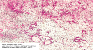 Light micrograph through a section of tissue from a human lip showing lip and oral cavity cancer.