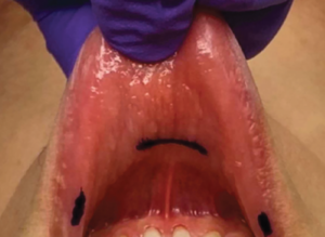 Figure 1. Intraoral incisions. A central incision approximately 1.5 cm is marked anterior to the labial frenulum. Two smaller lateral incisions are marked at the oral commissure.