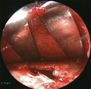 Figure 4: Intraoperative view after elevation of fractured anterior frontal sinus wall.