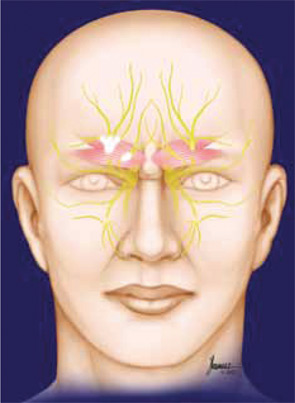 Surgery for migraine headaches in the forehead area involves removal of the frowning muscles, which irritate two nerve branches on each side of the forehead.