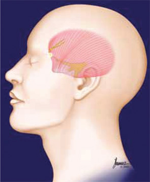 Surgery in the temple trigger site involves removal of a tiny branch of the trigeminal nerve.