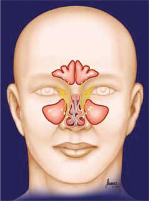 Migraines can also be triggered by contact between the turbinates and the deviated portion of the septum or the irregularities within the septal wall.