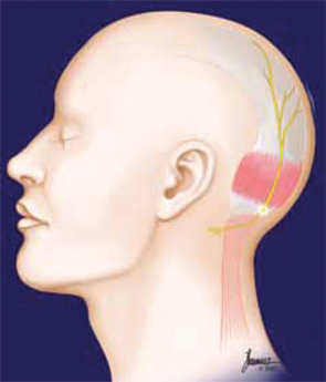 Migraines in the back of the head most commonly involve the greater occipital nerve.