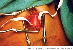 Gor-Tex partially implanted through bilateral thyroplasty windows